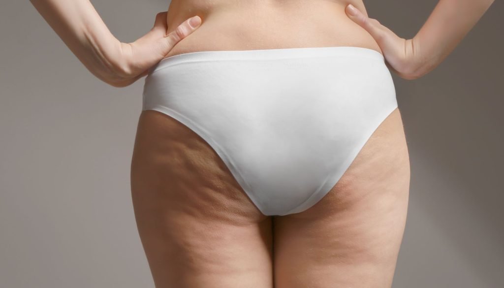 cellulite treatment 2