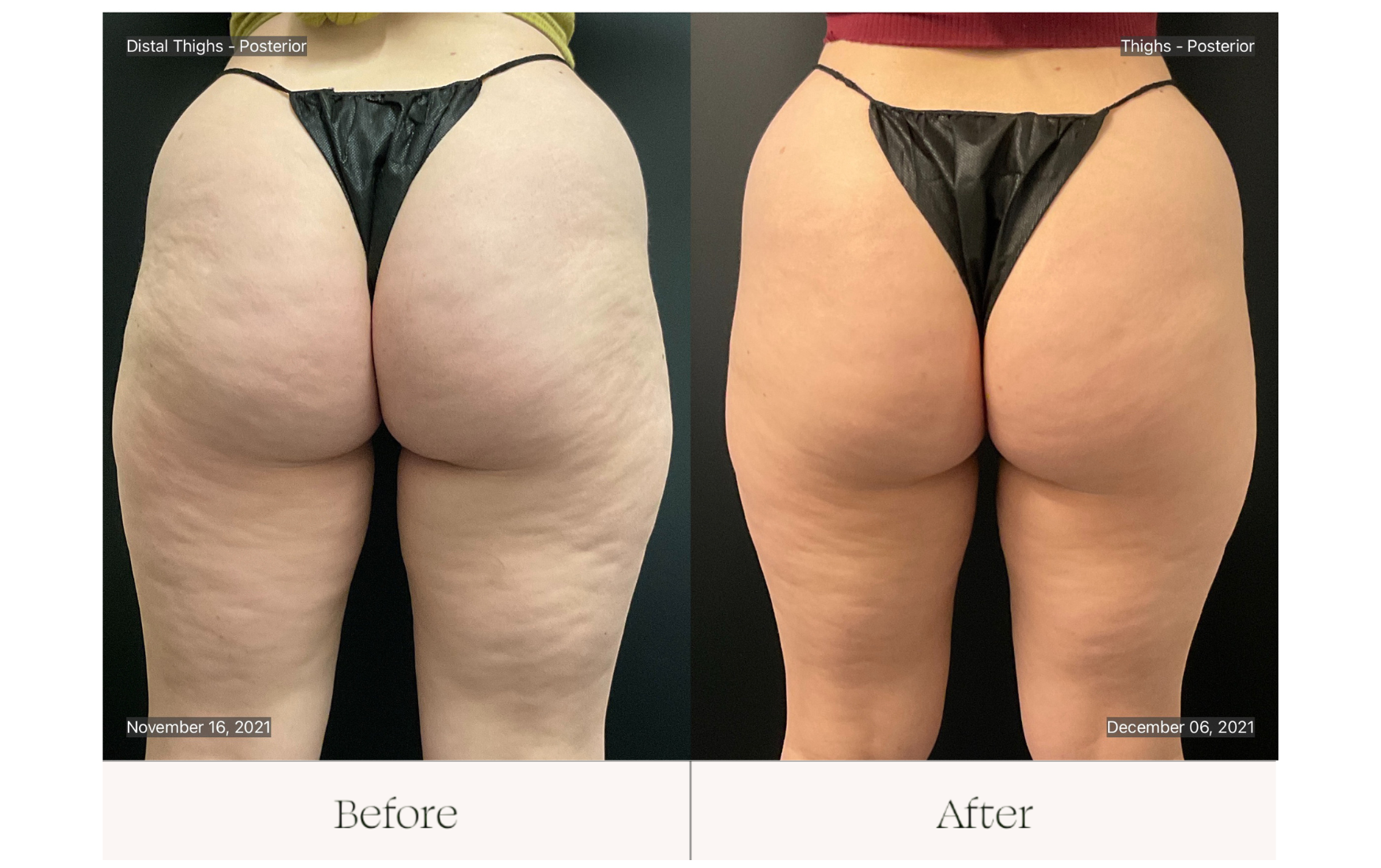Emsculpt neo skin tightening